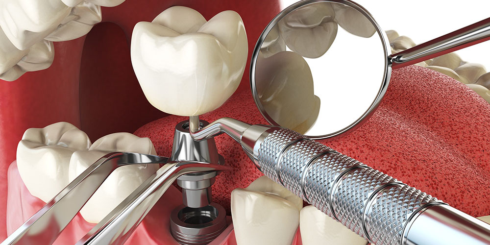 Remplacer une ou plusieurs dents. Option 1 : implants dentaires
