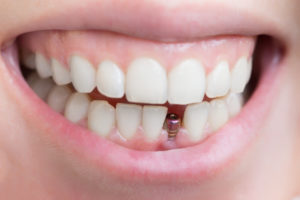 الأسنان المفقودة: أربعة حلول فعالة