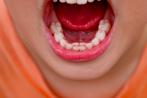 dents définitives qui poussent derrière dent de lait